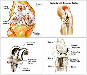 knee-replace-feature Knee Replacement Feature