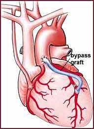 bypass-surgery Bypass Surgery