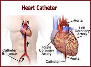 heart-catheter Cardiac catheterization