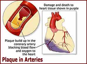 plaque-arteries Plaque in Arteries