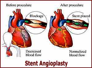 stent-angioplasty Stent Angioplasty