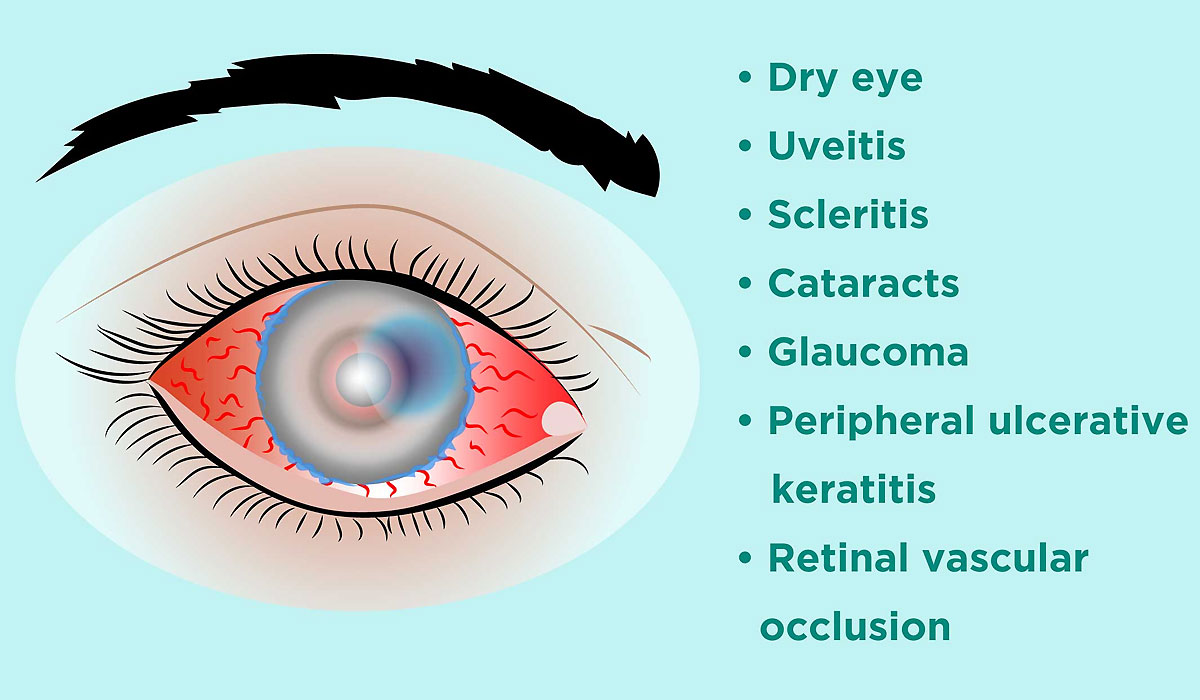 Age-Related Vision Problems-Causes, Symptoms and Treatments - Medical ...