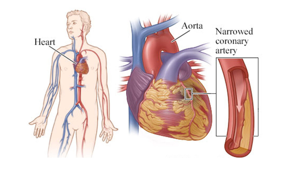 Blocked Coronary Arteries - Things You Should Know But Didn't ...