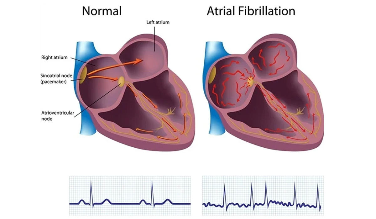 A Guide to Atrial Fibrillation - Medical Tourism in India | Top Health ...