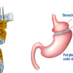 Gastric Banding (Lap Band Surgery) in India