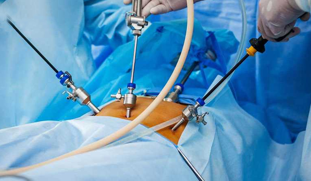 Laparoscopic Sleeve Gastrectomy Cost in India at Best Hospitals