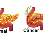 Pancreatic Cancer Treatment and Surgery in India