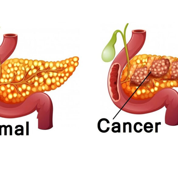 Cancer Treatment in India | Cancer Hospitals | Cancer Treatment