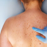 Skin Cancer Treatment in India