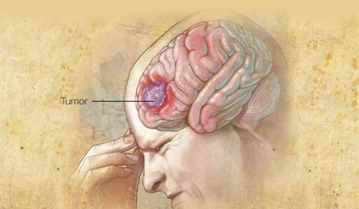 brain-tumor-surgery-cost-in-india-treatment-hospitals-cities