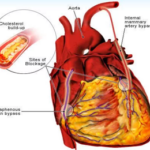 Coronary Artery Bypass(Heart Bypass) Surgery in India