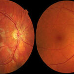 Age Related Macular Degeneration in India