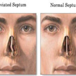 Septoplasty Surgery in India