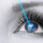 Refractive Surgery in India