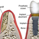 Bone Grafting(Dentures) in India