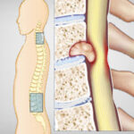 Spinal Tumor Surgery in India
