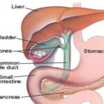 Cholecystectomy (Gall Bladder Removal) in India
