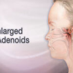 Enlarged Adenoids Treatment in India