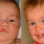 Cleft Lip and Cleft Palate Surgery in India