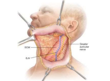 central neck dissection technique
