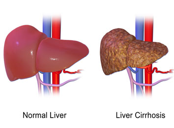 Liver Transplant Cost In India | Best Liver Transplant Hospitals