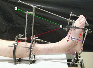 Ilizarov Technique in India Limb lengthening Surgery Cost