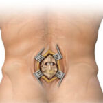 Spinal Fusion Surgery in India