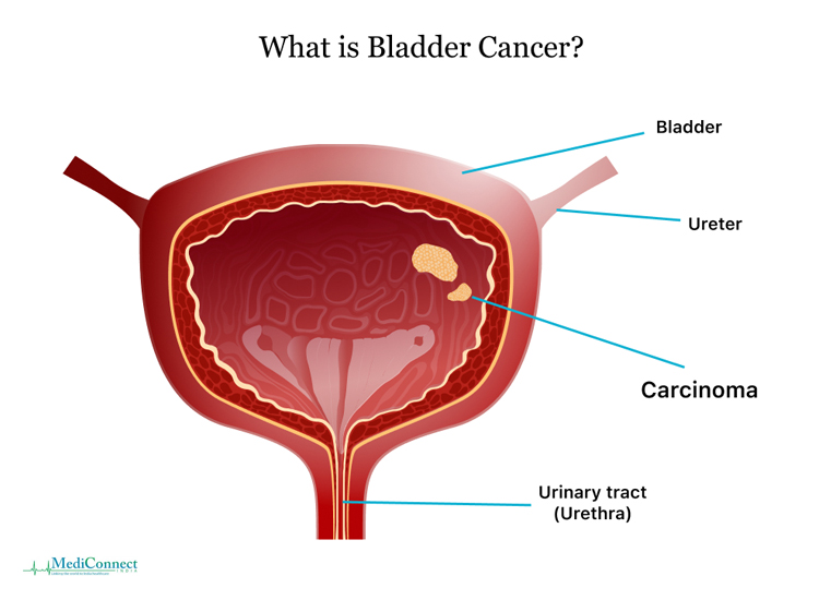 How can you prevent getting Bladder Cancer? - Urologist Ahmedabad